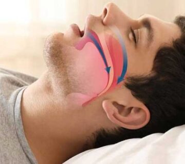 آپنه خواب چیست و چه علائمی دارد؟